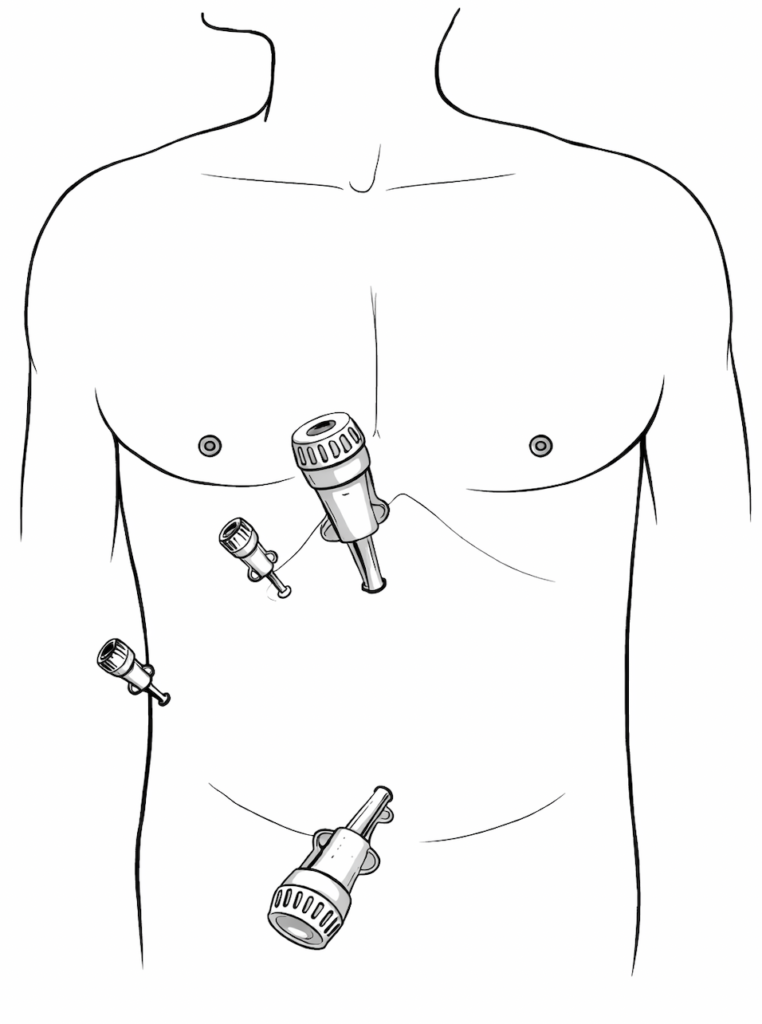 Imagem mostra os locais onde são feitas as incisões para colocar os instrumentos da laparoscopia na cirurgia de vesícula.
