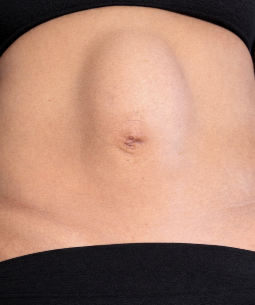 mulher com diástase