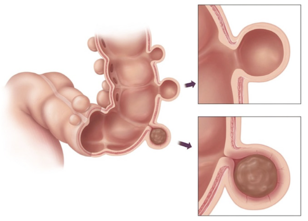Imagem evidenciando doença diverticular do intestino grosso, onde se formam bolsas, que podem inflamar causando diverticulite.