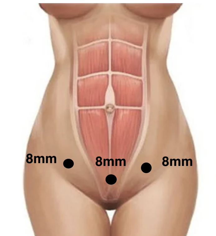 Na imagem, os 3 pontos pretos representam os locais onde são realizados as incisões para inserir os instrumentos do robô.