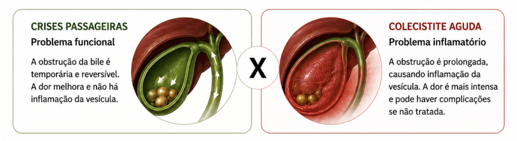 Diferença entre pedra na vesícula e colecistite aguda (inflamação da vesícula).