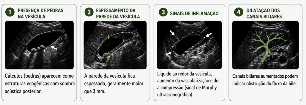 Imagens de ultrassonografia evidenciando pedras na vesícula e sua complicações.