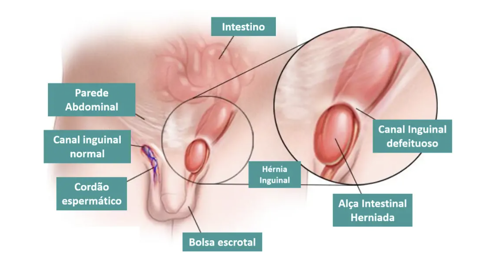 Hérnia inguinal