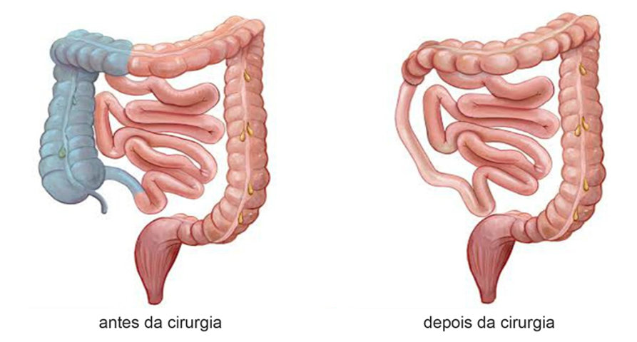 Imagem mostrando o antes e depois da retirada do intestino grosso do lado direito.