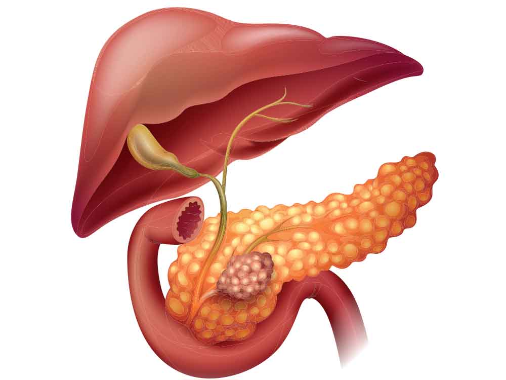 cancer de pancreas