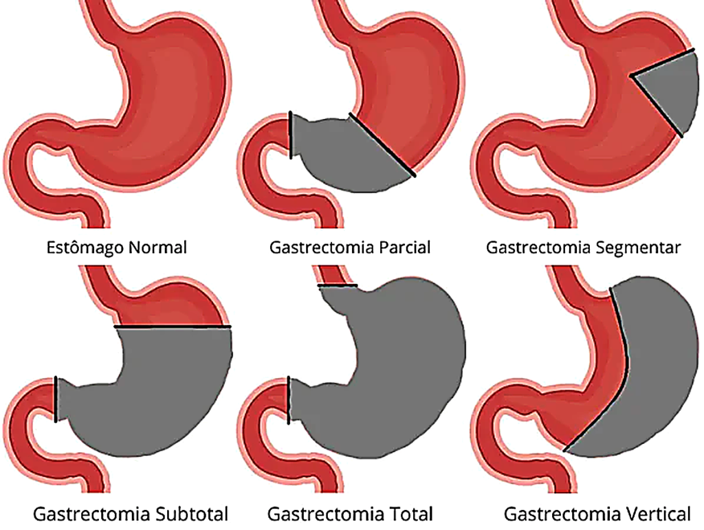 Imagem mostra os tipos gastrectomias (retirada do estômago).