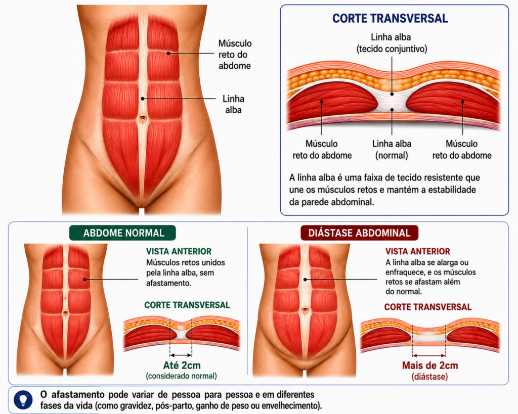 o que é diástase abdominal